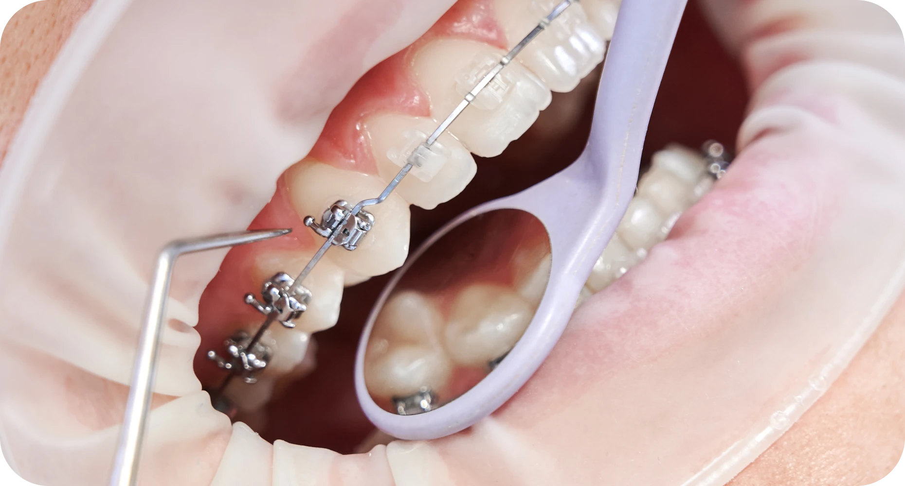 appareils dentaires cabinet nice Incidents en orthodontie Orthodontiste Nice, Docteur Nathan Israel