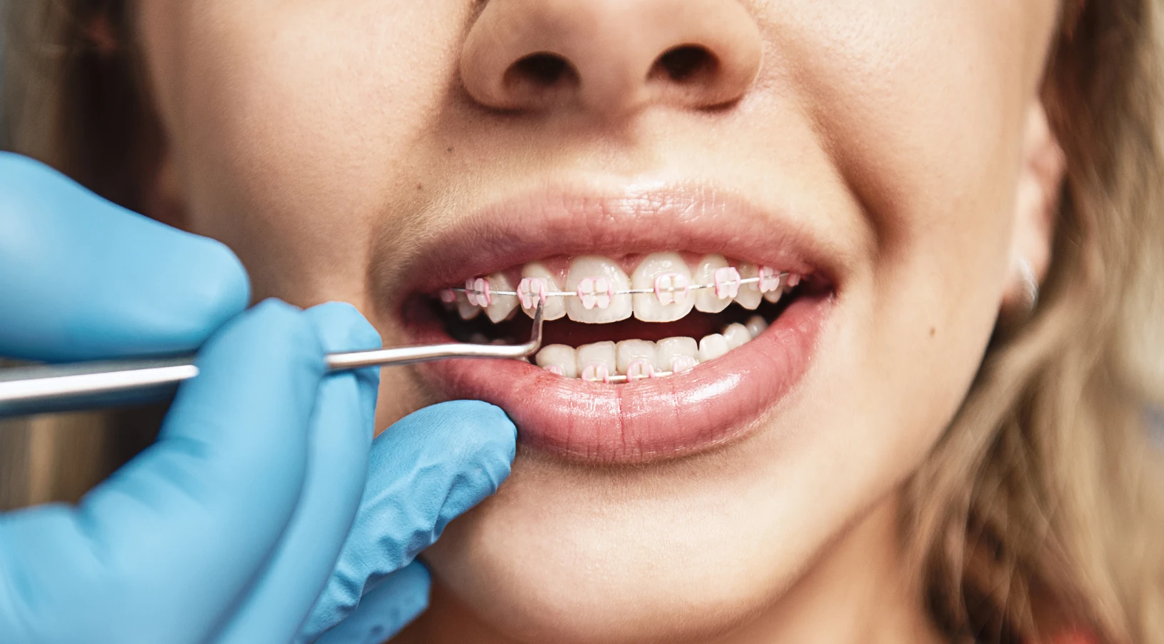 multi-bagues-adultes orthodontiste nice