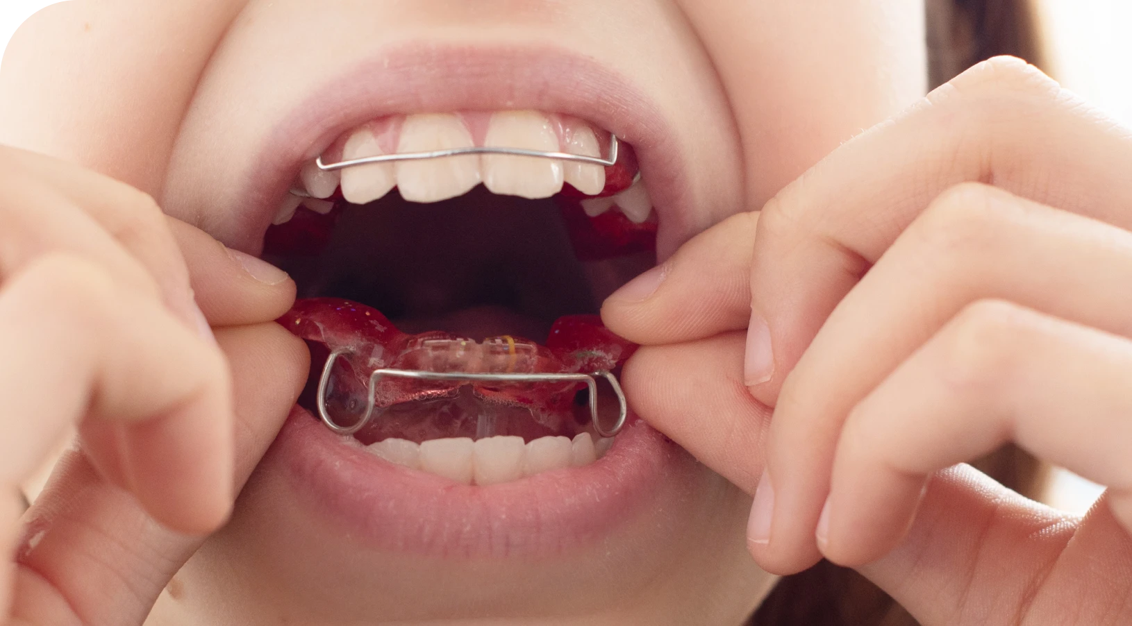 orthodontie interceptive croissance machoire PUL (Propulseur Universel Light) Orthodontiste Nice, Docteur Nathan Israel